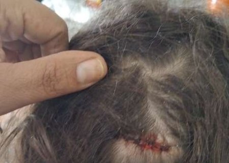 Menina de 7 anos &eacute; atingida na cabe&ccedil;a por bala perdida enquanto dormia em casa